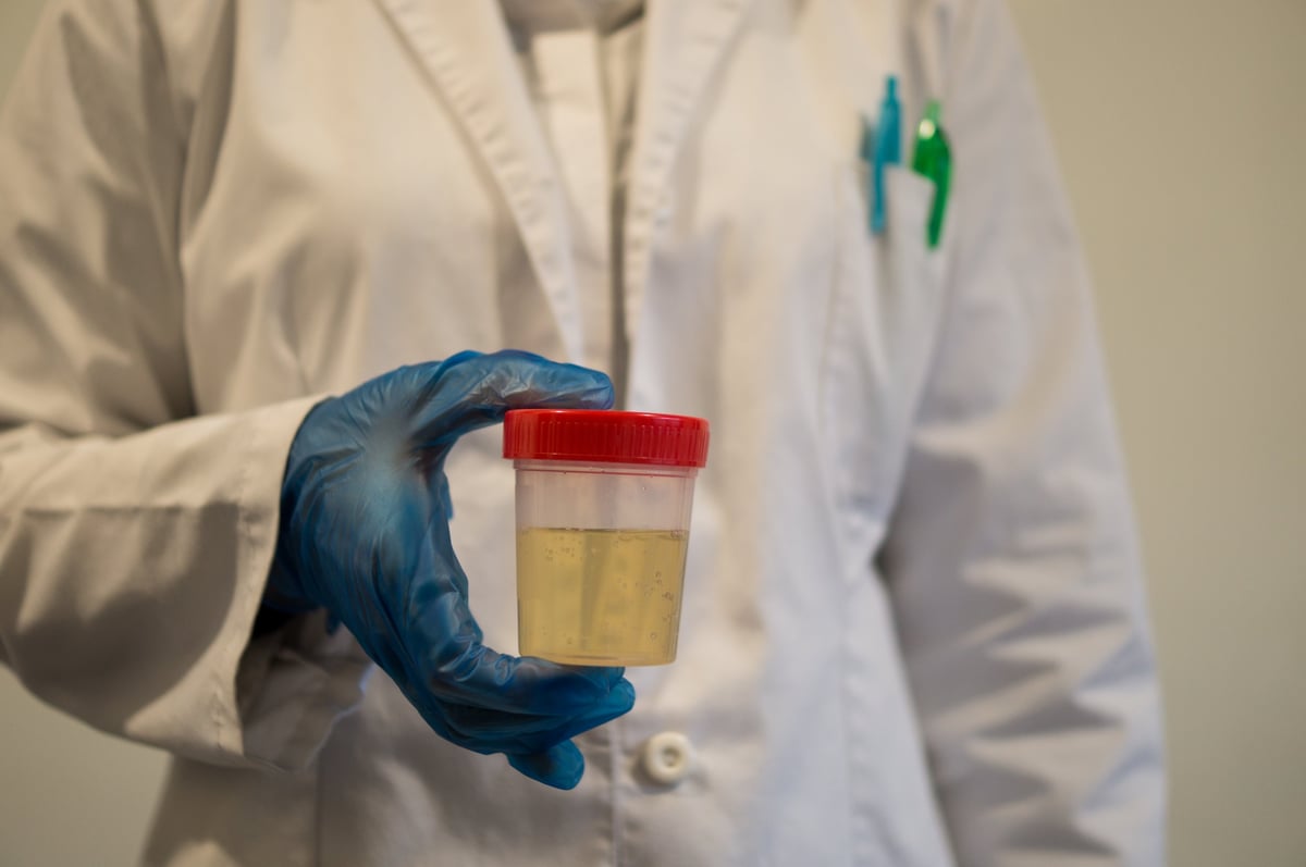 A close-up of a person in a lab coat holding a urine specimen cup filled with a yellowish liquid, wearing a blue disposable glove.